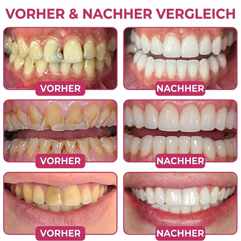 Purelora® DenPerm – Natürliches Zahnschmelz-Füllgel zur Kariesreparatur