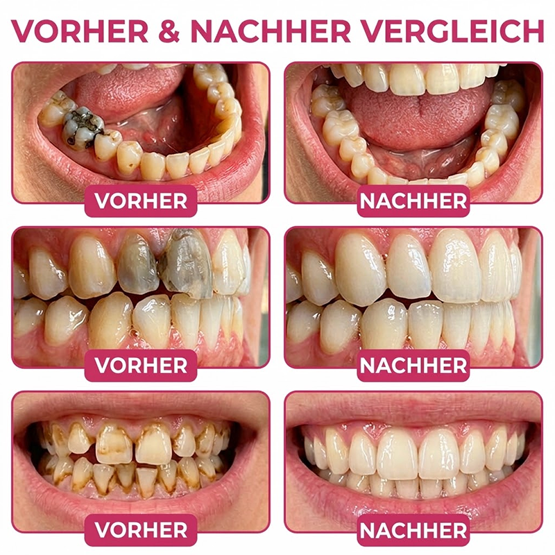 Purelora® DenPerm – Natürliches Zahnschmelz-Füllgel zur Kariesreparatur