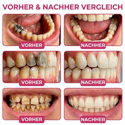 Purelora® DenPerm – Natürliches Zahnschmelz-Füllgel zur Kariesreparatur